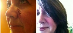 Scar-from-Stitches-on-nose